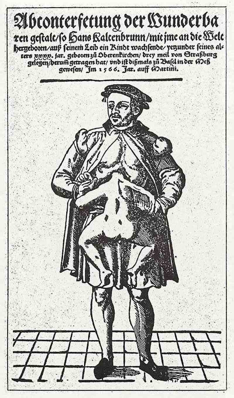 Abnormal birth: Hans Kaltenbrunn, born in Obernkirchen near Strasbourg. German master of the 2nd half of the 16th century