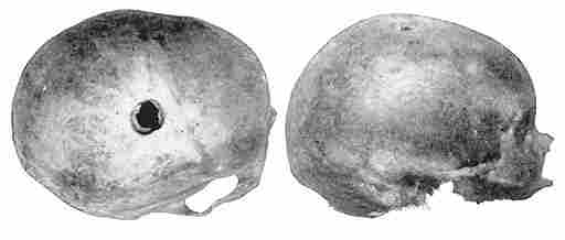 Trepanned Tarahumare Skull, Female.